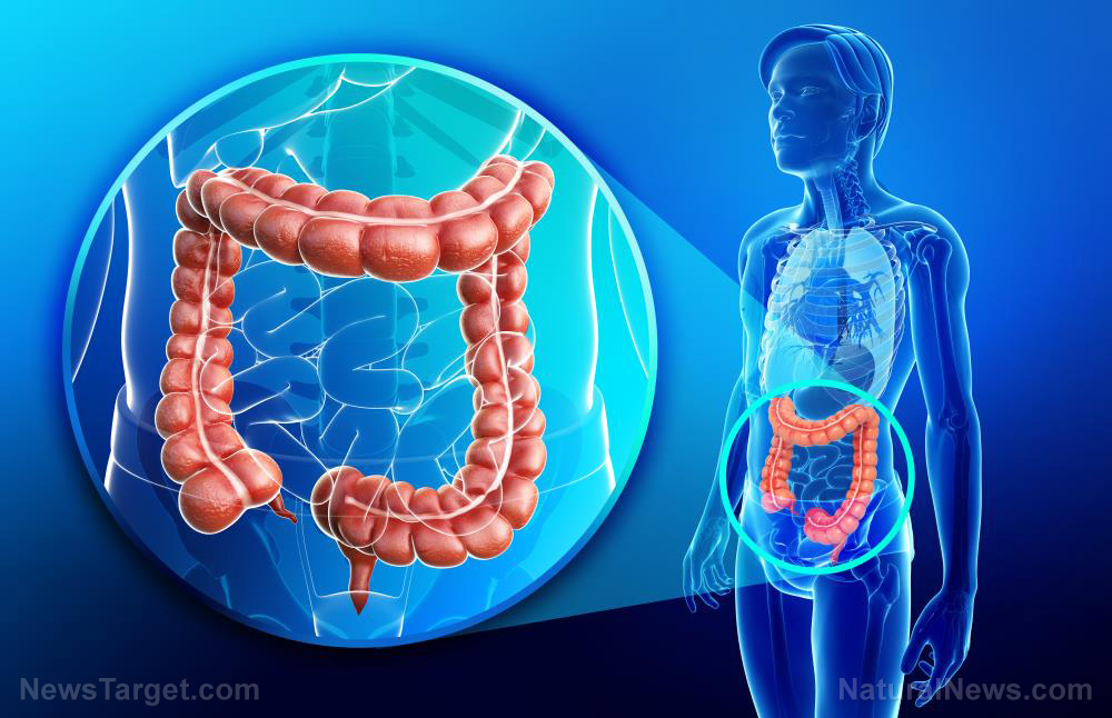 Colorectal cancer is a microbial disease: Changes in the gut microbiome can be used for early detection