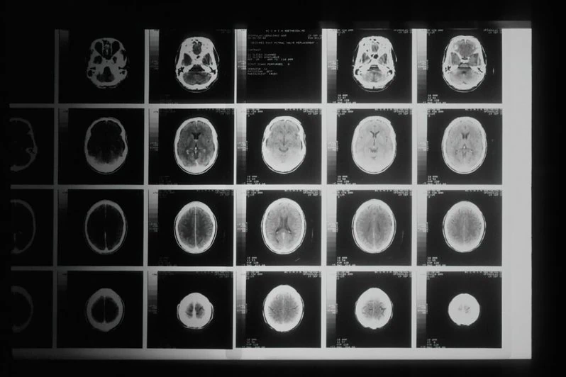 UF Health researchers use AI to improve brain tumor analysis